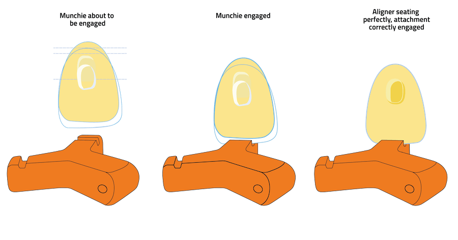 Line drawing showing an orange Munchie about to be engaged with tooth containing an attachment and clear aligner, then Munchie engaged with tooth and aligner seated perfectly