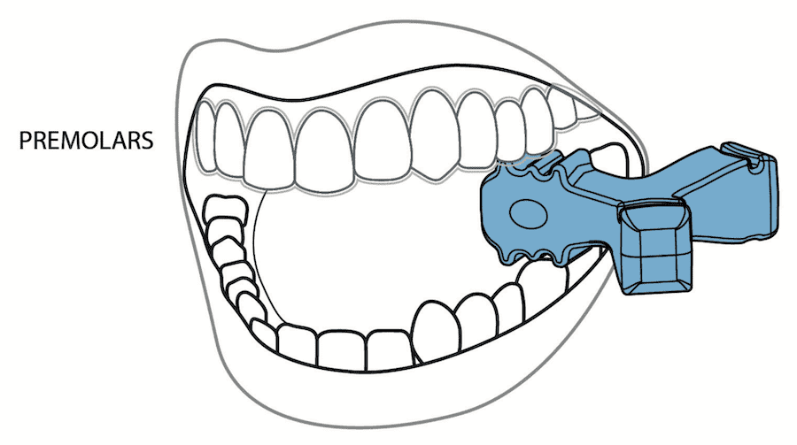 EPS line drawing: Line drawing showing how to place and use Munchies® EPS on the premolars