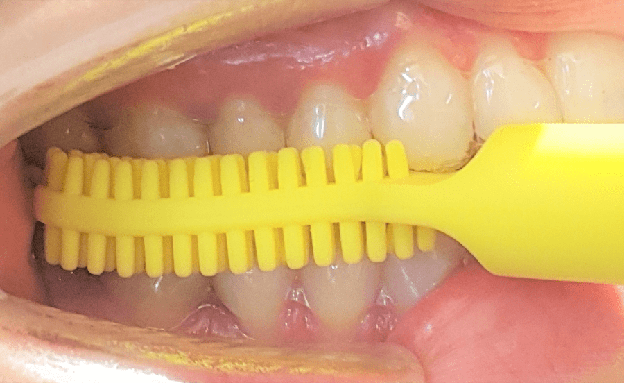Side, close-up view of Munchies® VIBE posterior nodular attachment head engaged with posterior teeth.