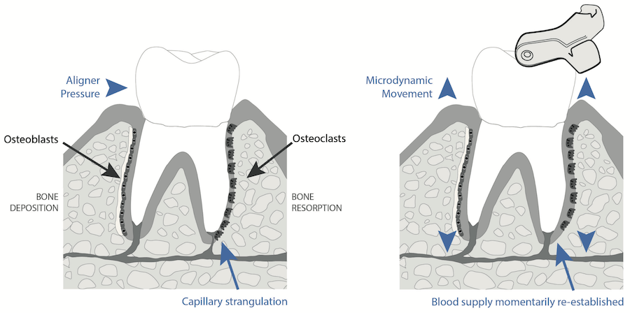 Orthodontic analgesic: Line diagram showing how capillary strangulation occurs with clear aligners and how Munchies® can relieve pain