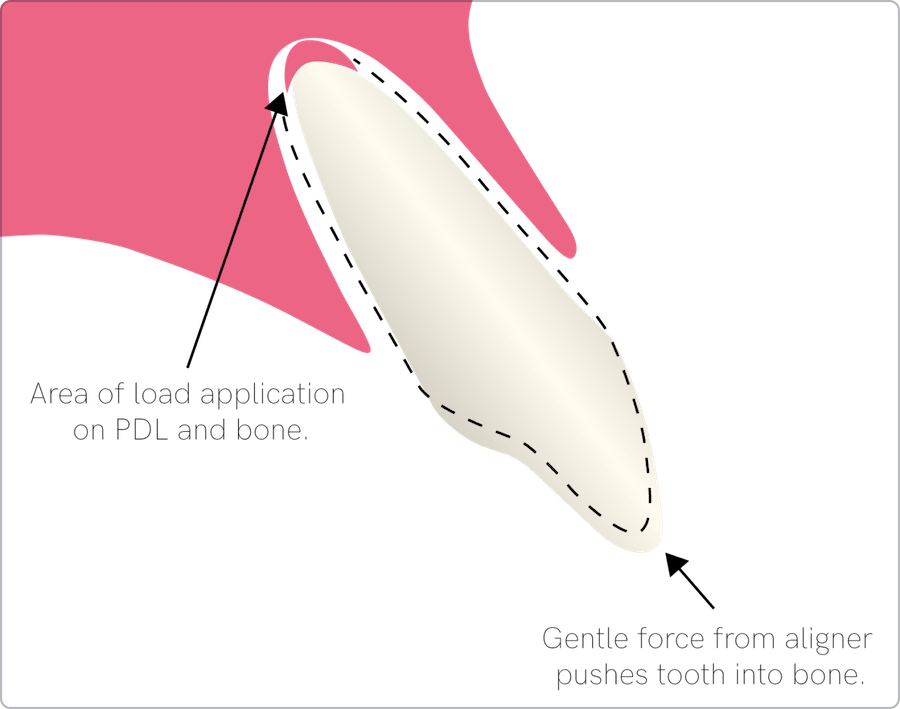 Increase intrusion predictability (1): Line diagram showing canine tooth being subjected to force and being pushed into bone