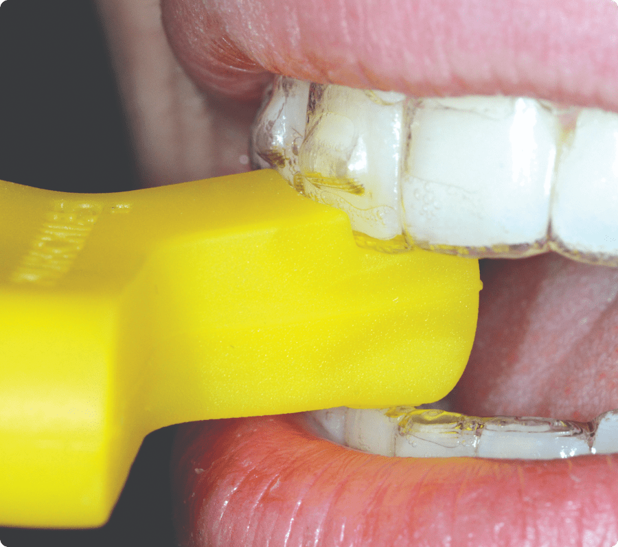 Close-up of yellow Munchies (1): Side, close-up view of Yellow Munchie about to engage clear aligner with incisal gap shown