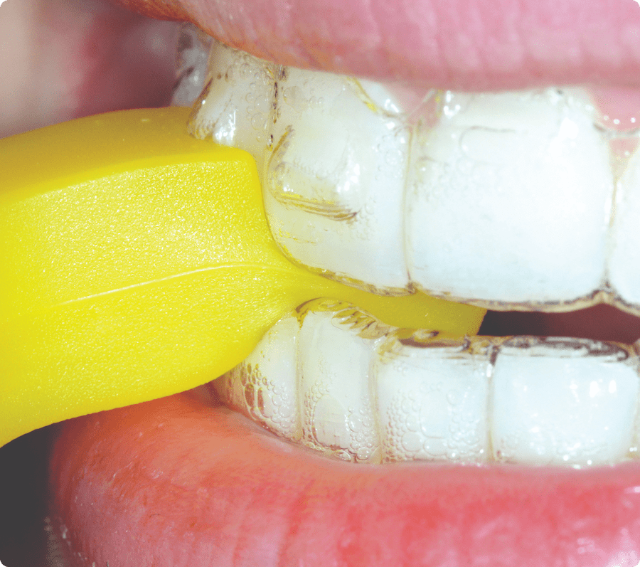 Close-up of yellow Munchies (2): Side, close-up view of Yellow Munchie engaging and seating clear aligner at the central incisor